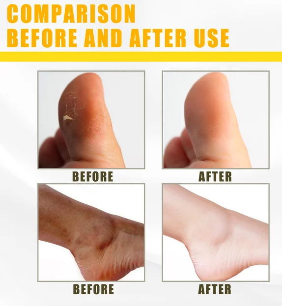 Best sale anti stretch marks multiple functions wholesale eternalelinor yellow peeling oil customized