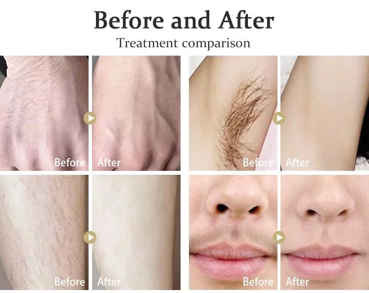 50%DISCOUNT! 808nm diodes laser beauty equipment diode laser triple waves germany diode laser hair removal machine