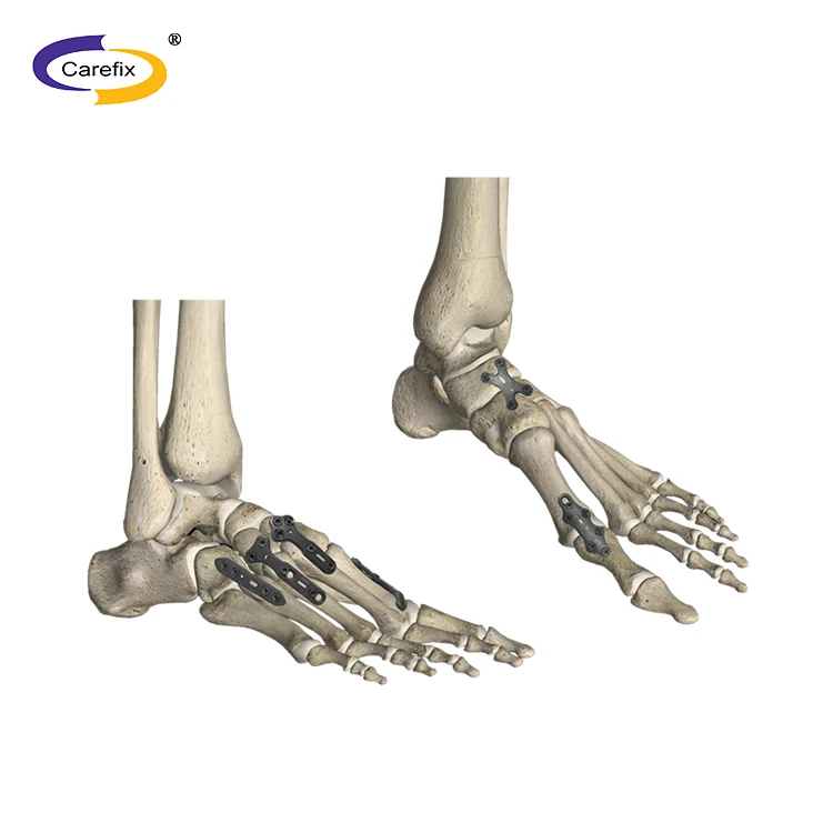  Straight Locking Mini Plate Screw for Foot Ankle Elbow Fracture LCP Meditech Orthopedic