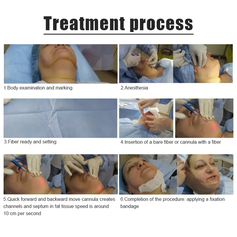 Liposuction Vibration Liposuction Vibrolipo Unit For Plastic Surgeon Assisted Liposuction