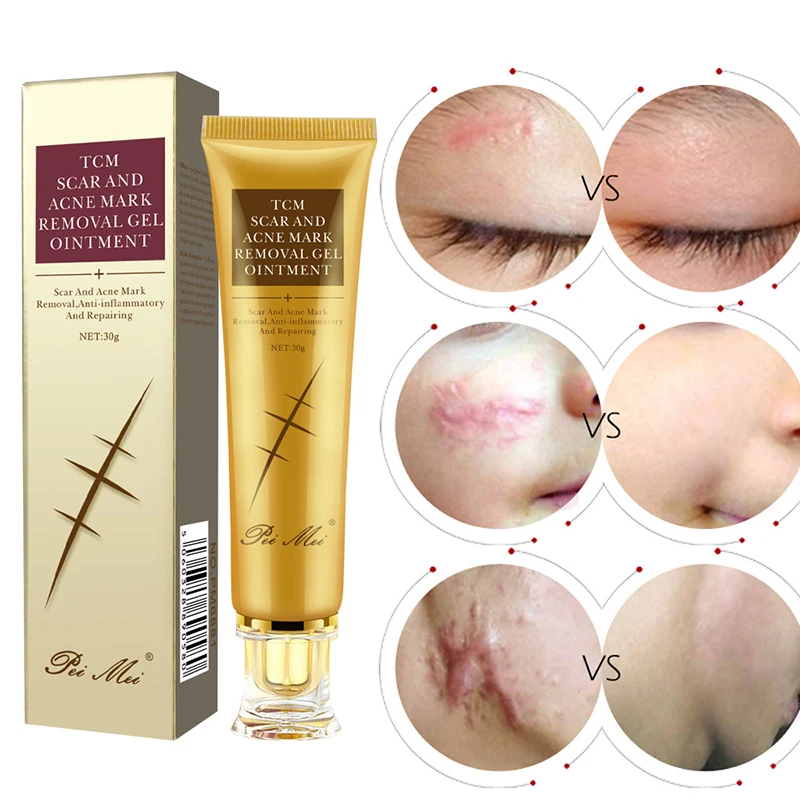 Light Print Scars Removal Face Cream Beauty Pure Skin Care Whitening Facial Moisturizing Acne Treatment Face Burn Scar Removal C