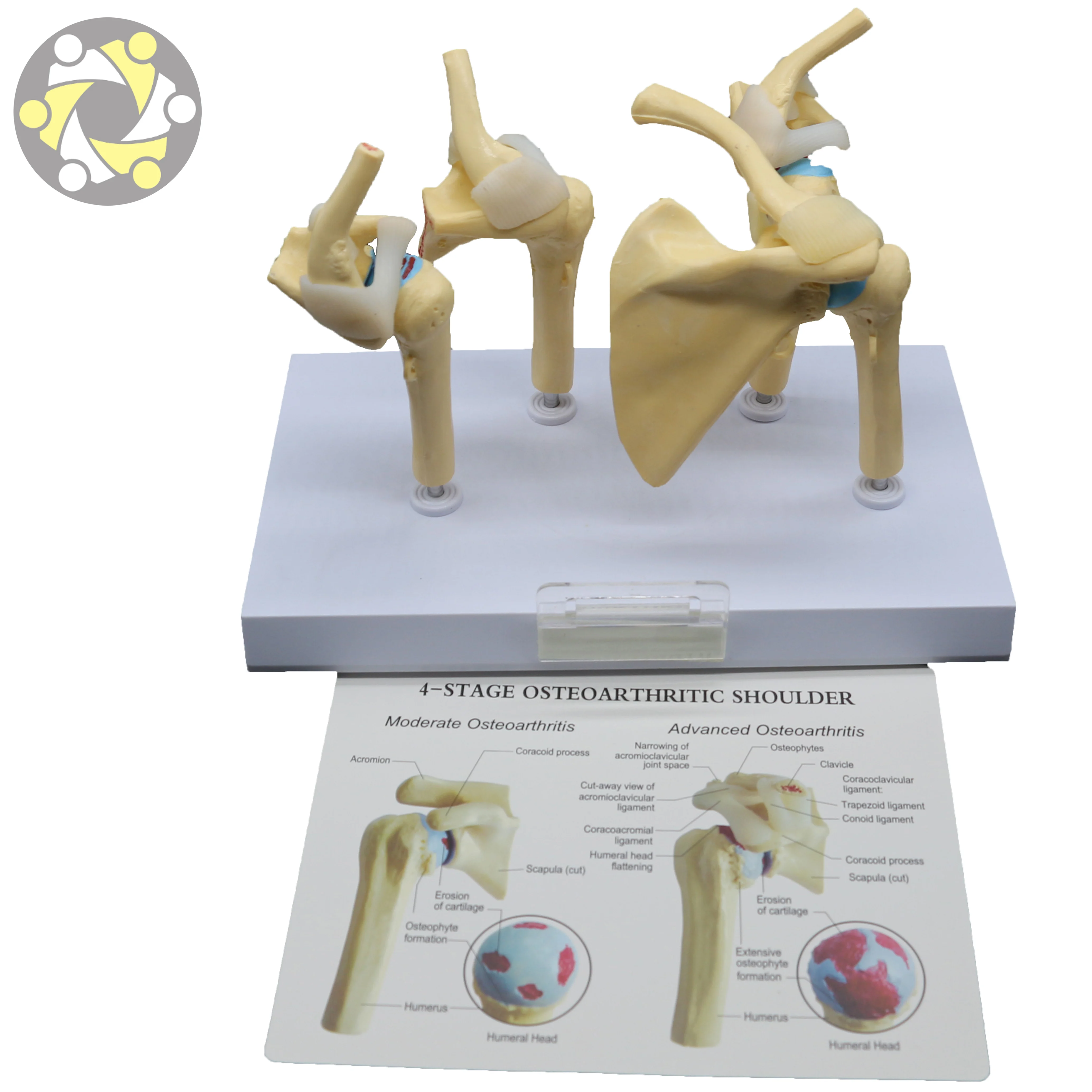 Medical Science Skeleton Model Human Diseased 4 Stage Osteoarthritic Shoulder Model for Teaching