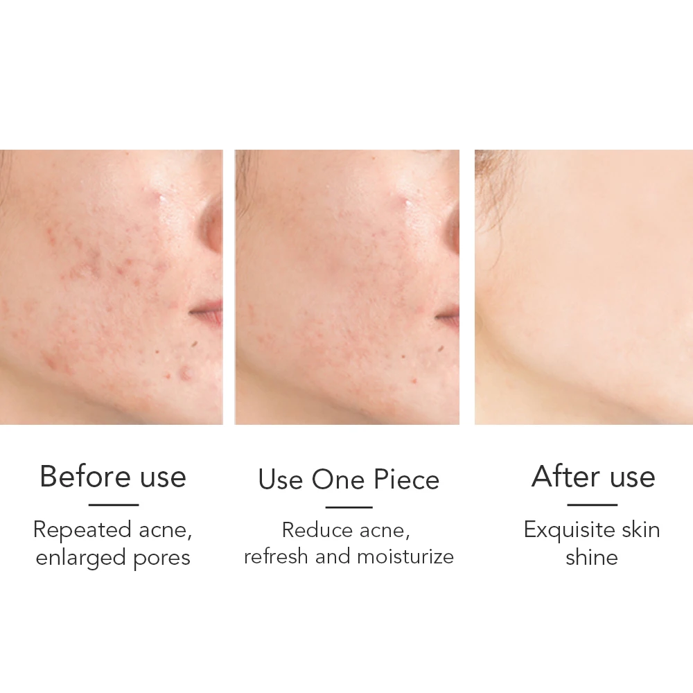  Anti-acne Oil Control Facial Care Soap Bleaching Hemp