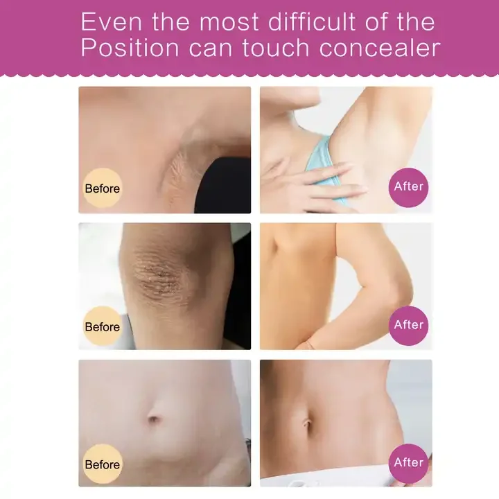 Отбеливающий крем для женского тела интенсивный отбеливающий подмышек чувствительных областей