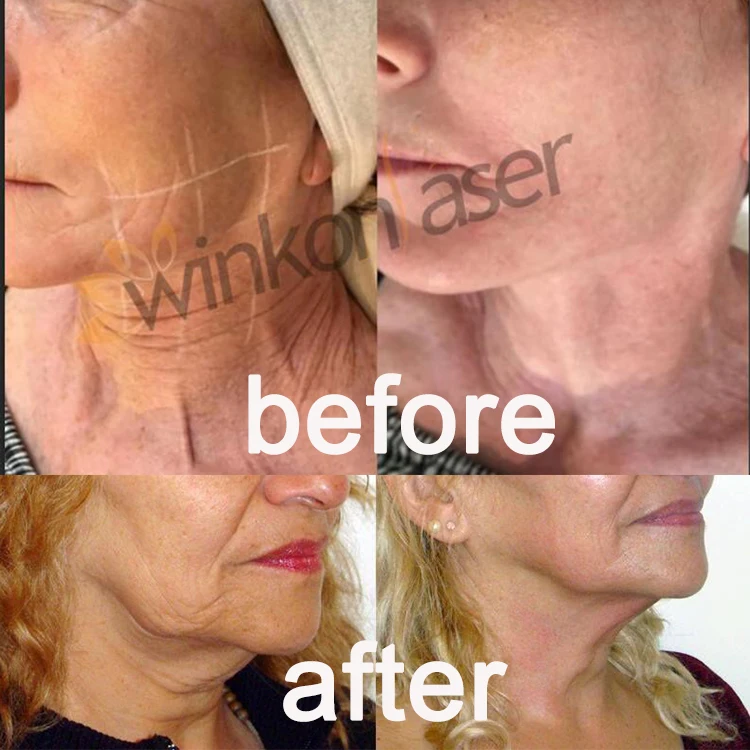  Winkonlaser 3D 4D 5D Hifu 25000 снимков 11 линий 8 картриджей против морщин Подтяжка кожи лица тела похудение