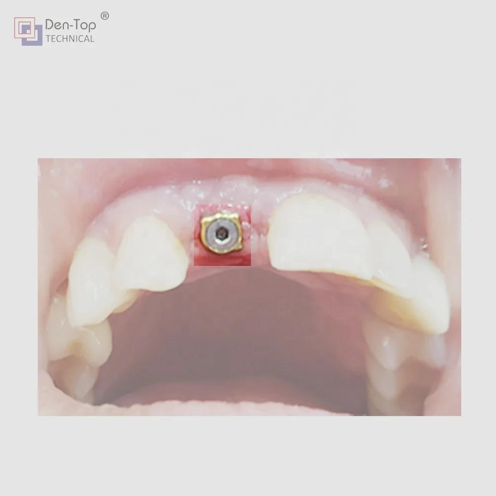 conical connection compatible  titanium implant abutment for healing gingival height 1 - 5 mm