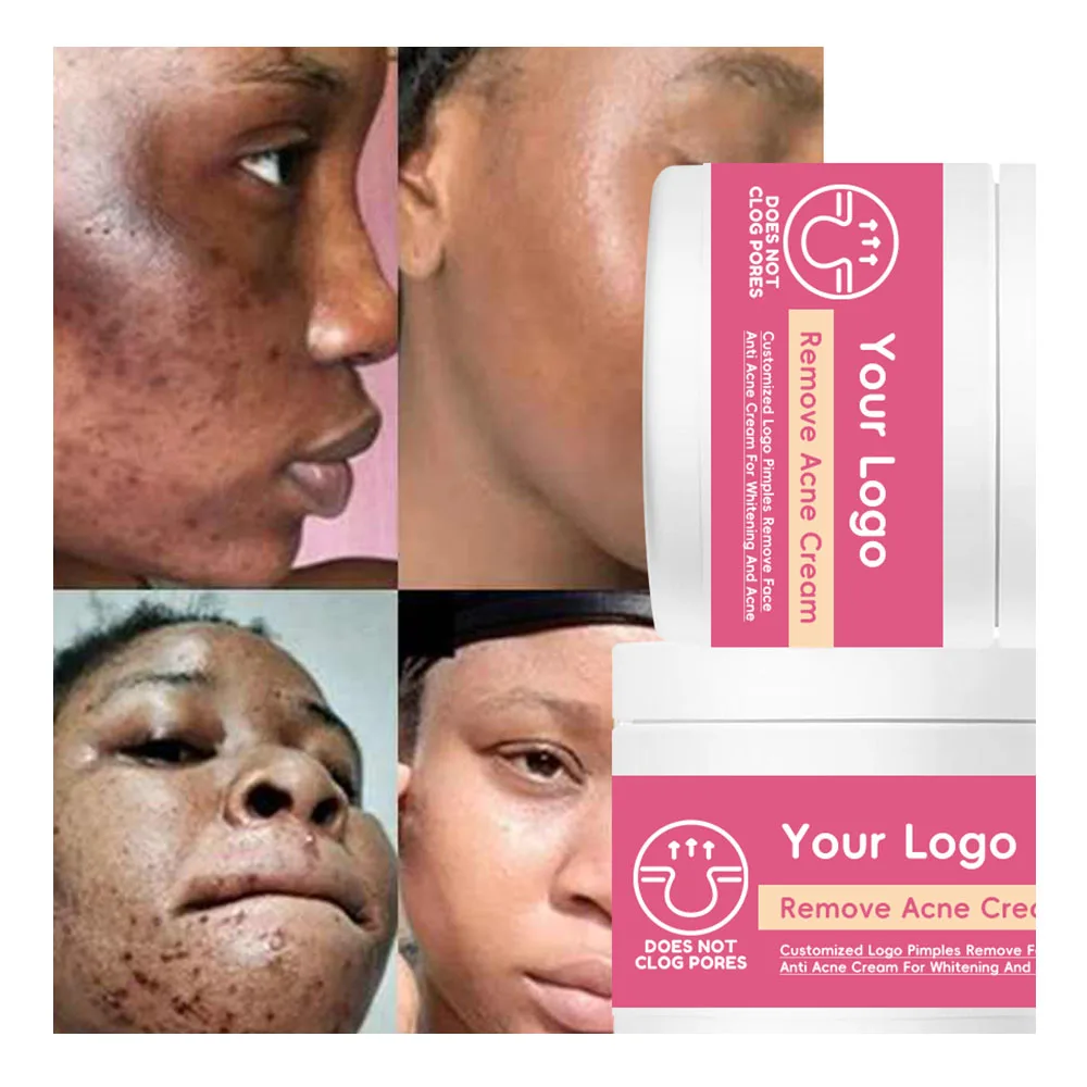 Benzoyl Peroxide Topical Pimple Cream Acne for Face Targets Blemishes Reduces Redness Calms Clears