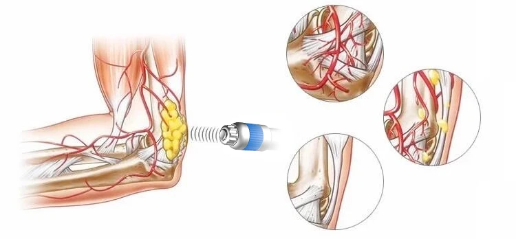 OEM ODM Shock Wave Therapy ED Extracorporeal Shockwave Therapy for Penis