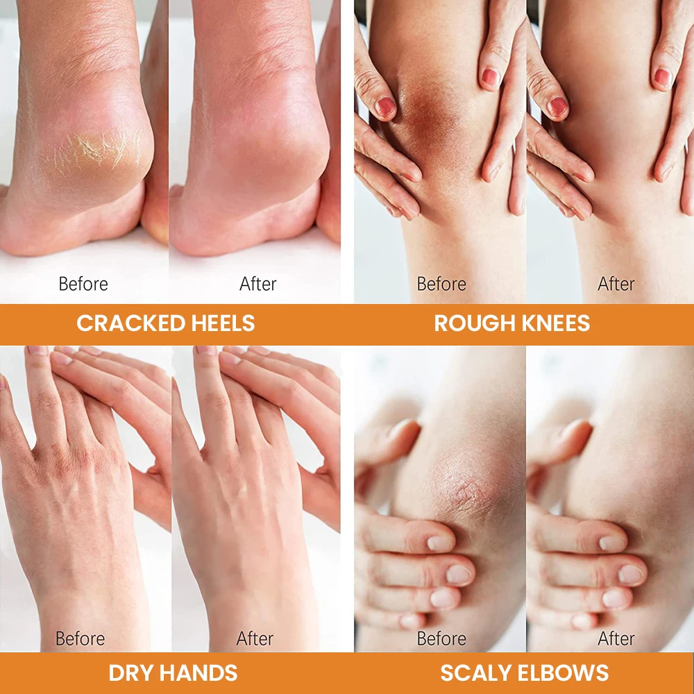 Best 42% Urea 2% Salicylic Acid Dry Cracked Heel Remover Urea Foot Cream Dead Skin Removal Cracked Heels Foot Cream