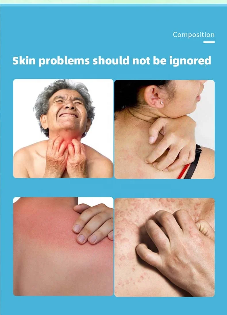 Anti-inflammatory Itching Relieve Skin Herbal  Disease Relieve Itching Pruritus Psoriasis Cream Ointment