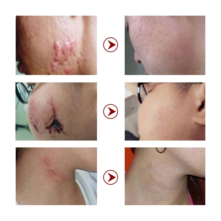 Make Your Own Body Skin Care Skin Repair Remove Clear Pregnancy Scar Removal Stretch Mark Cream