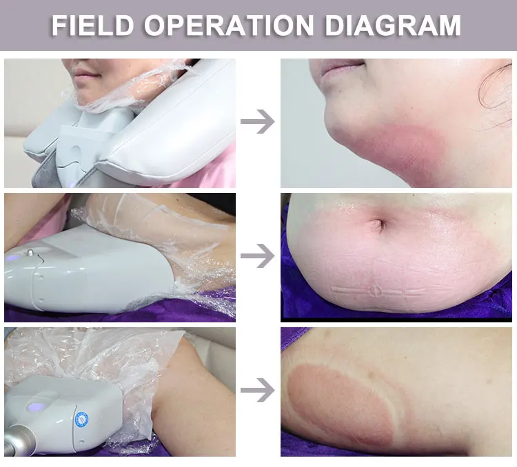 cry90b cryotherapy (11)