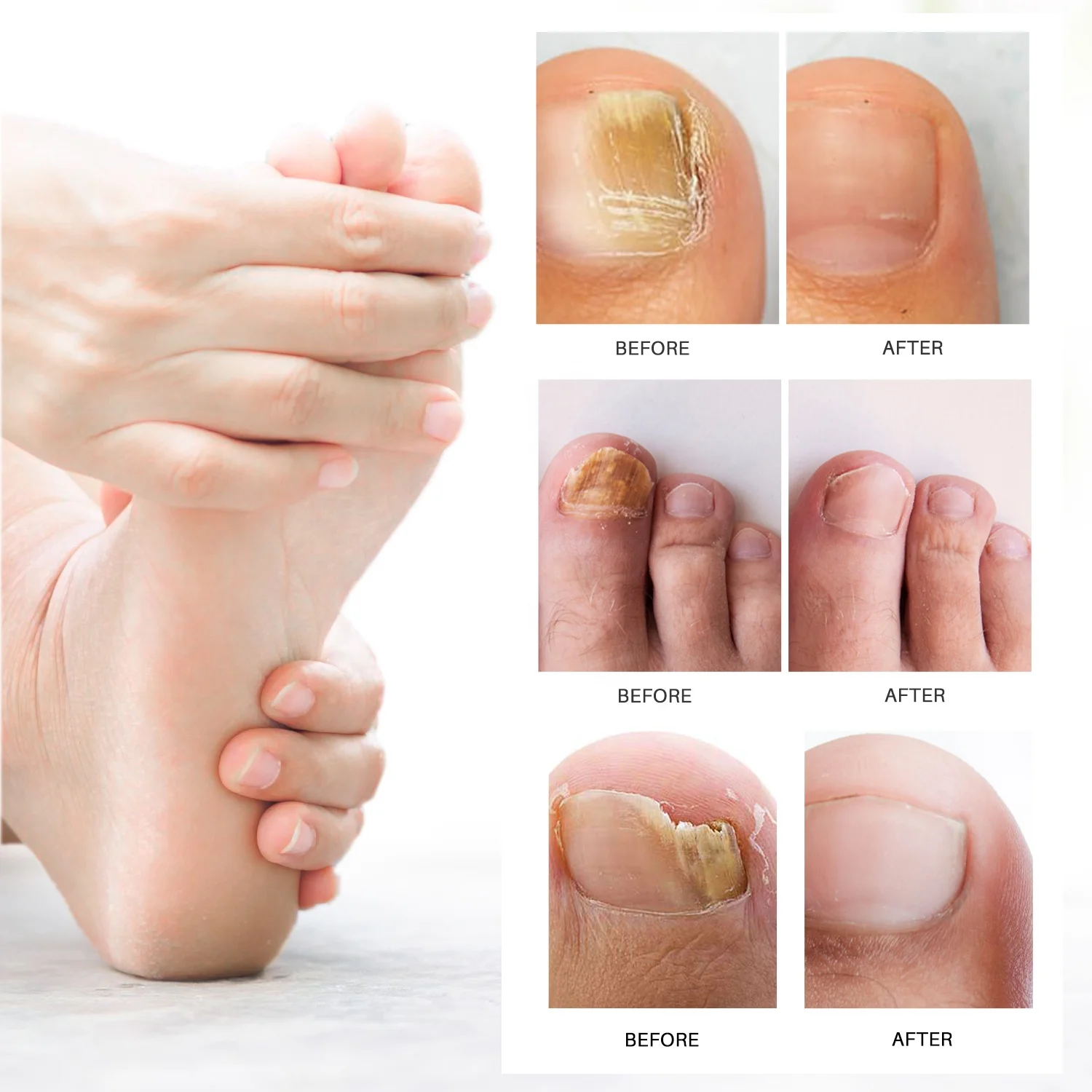 Lanthome Nail Fungus Removal Cream Onychomycosis Fungal Treatment Paronychia Anti Infection Feet Toe Fungal Care Ointment