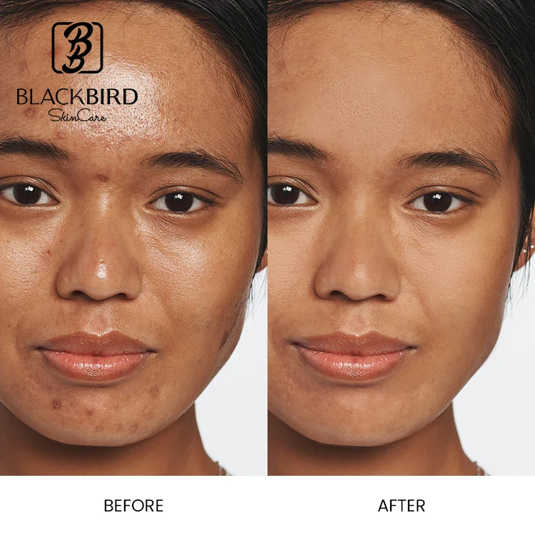 Private Label 5% Azelaic Acid Brightening 50g Facial Cream Natural Organic Whitening Hydrating Anti Aging Beauty Face Cream