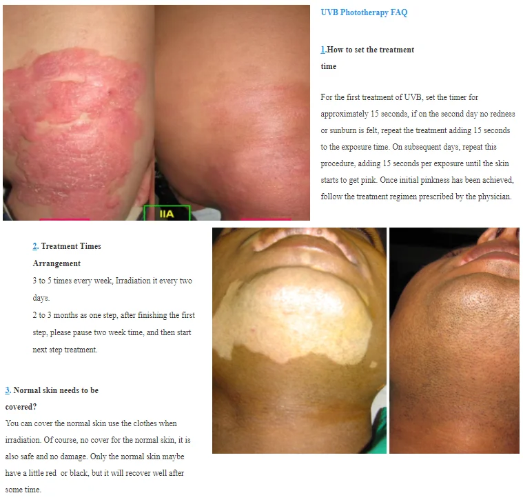 Kernel KN-4003bl 9w uvb 311nm uv wand lamp phototherapy physical psoriasis treatment device