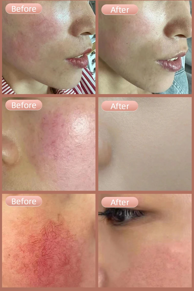 2024 Newest 980nm 1470 diode laser spider vein removal machine 980nm vascular laser machine