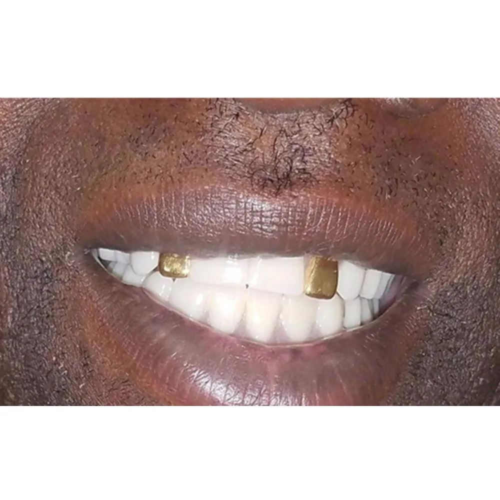 SowSmile Hip Hop Gold Grills Party Playing Snap on Dental Upper Lower False Teeth Cover Perfect Smile Veneers Dentures Equipment