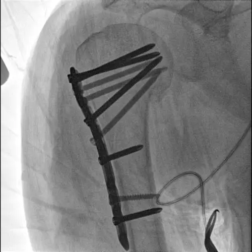 Advanced Mobile C arm x ray system with dual touch control