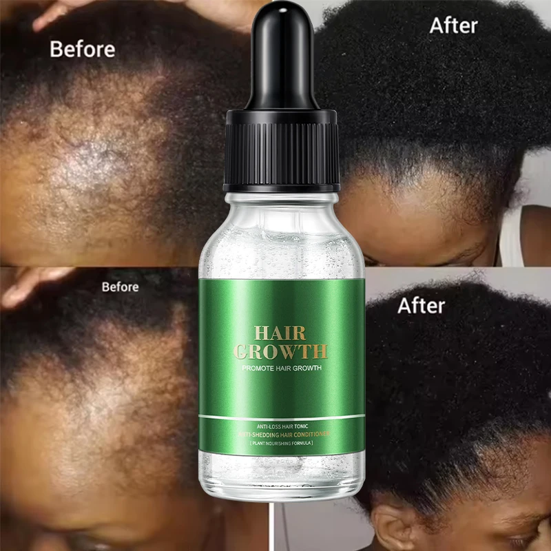 Hair Regrowth Treatment Growth Strengthens Damaged Hair Loss Revitalizes Scalp Hair Care For Men & Women