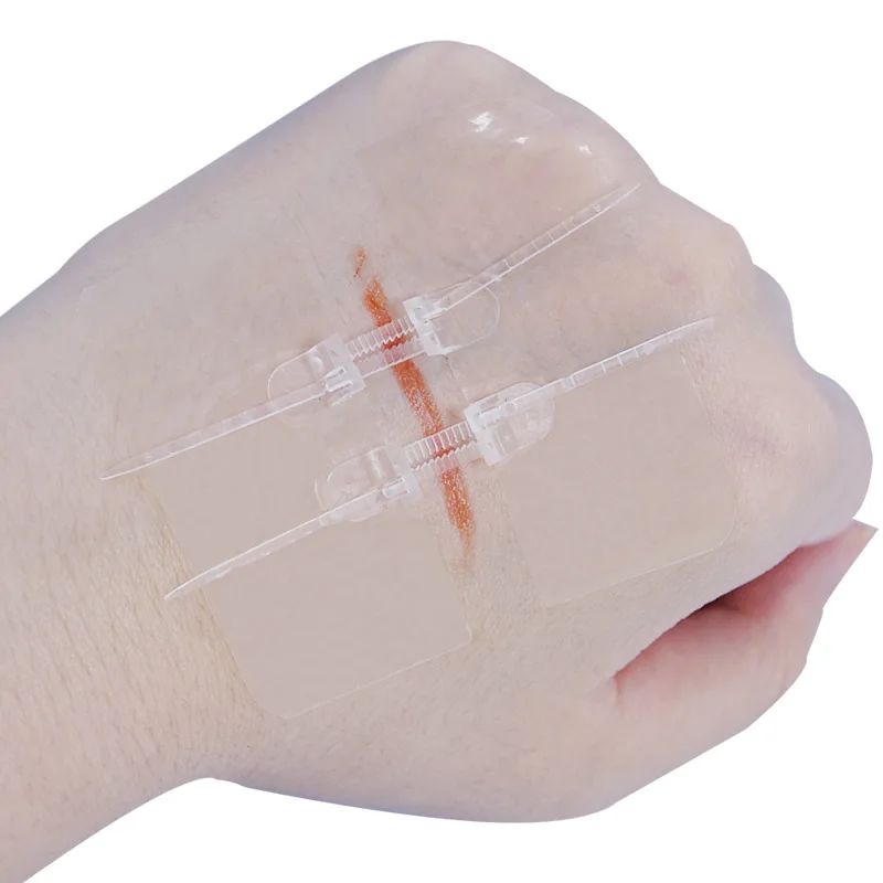 CE Approved Zip Type Wound Closure For Medical Surgery Use Zip Stitch