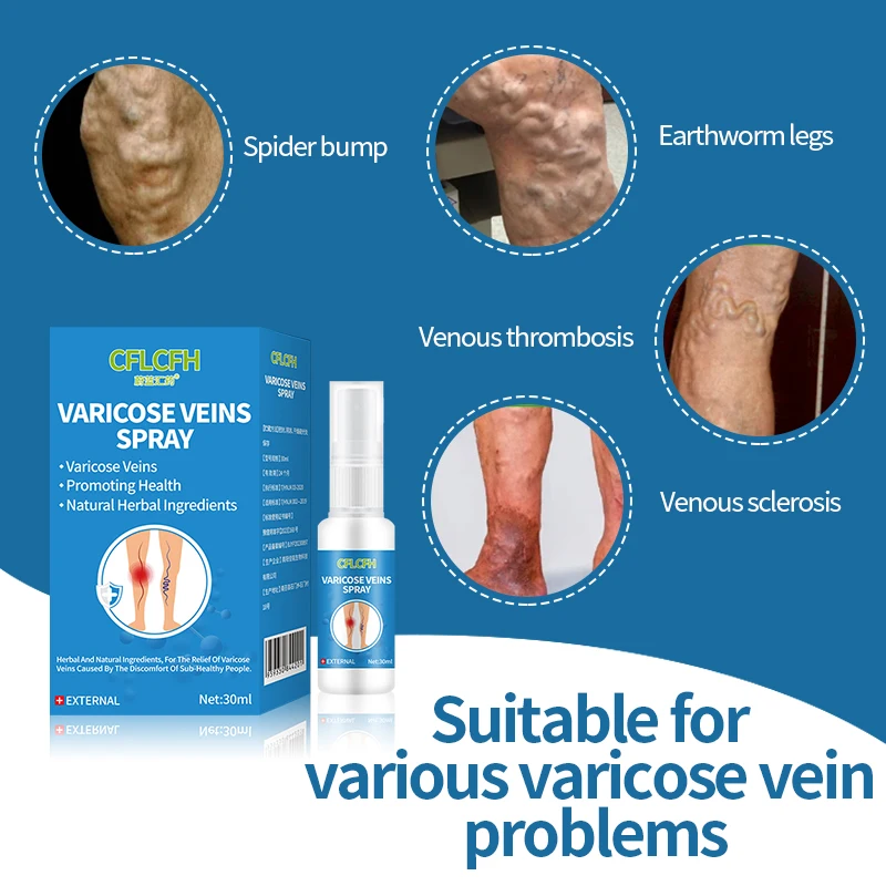 Varicose Vein Spray Spider Varicose Veins Relief cream Herbal Ointment 30ml