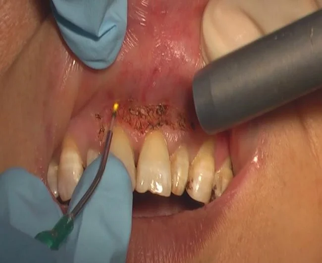 980nm 15w dental laser machine diode laser with treatment handpiece dental equipments