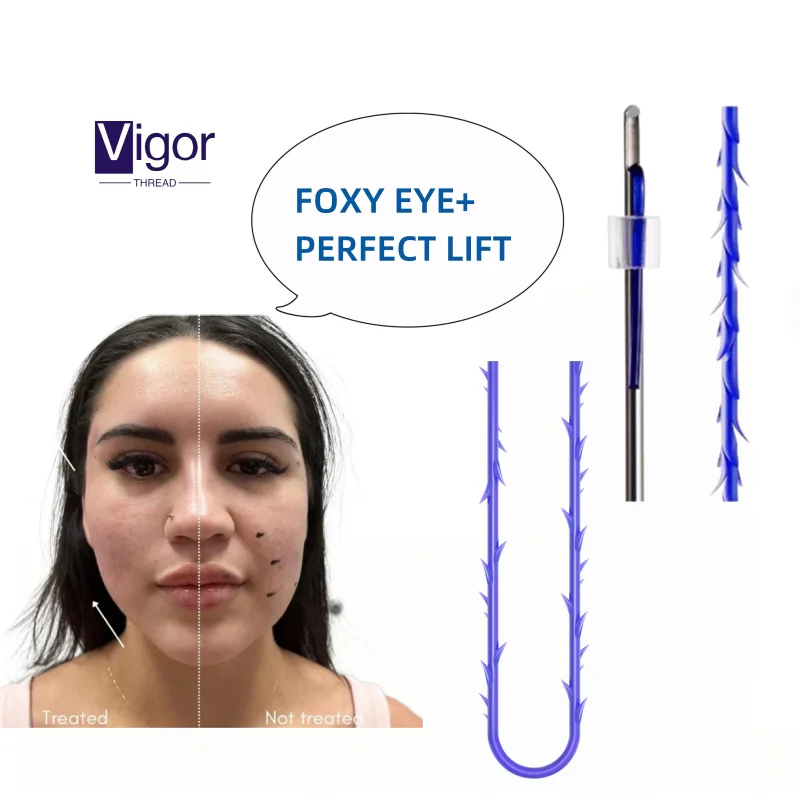 Vigor korean pdo barbed suture for the pdo thread lift double needle facial tension tornado pdo thread lift double needle