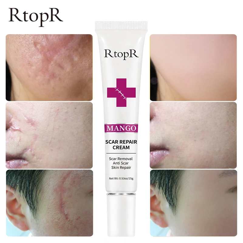 RtopR Acne Scar Stretch Marks Remover Cream Skin Repair Face Cream Acne Spots Acne Treatment Blackhead Whitening Cream Skin Care