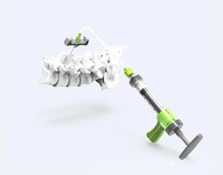 Orthocare Orthopedic Surgery CE EO Sterile PKP Transparent & Light Green Bone Cement Injector