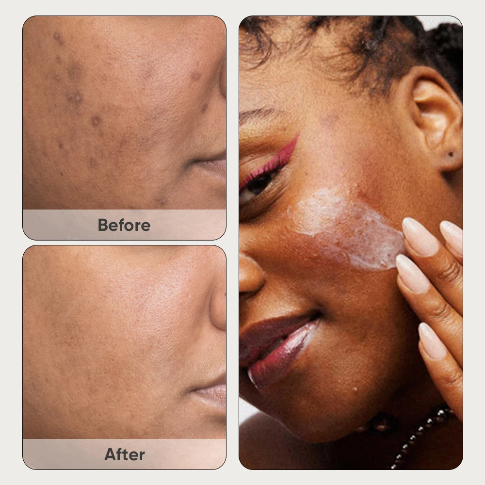 Private Label Azelaic Acid Hyperpigmentation Corrector Faded Dark Spot Discoloration Moisturizer Balances Face Skin Serum