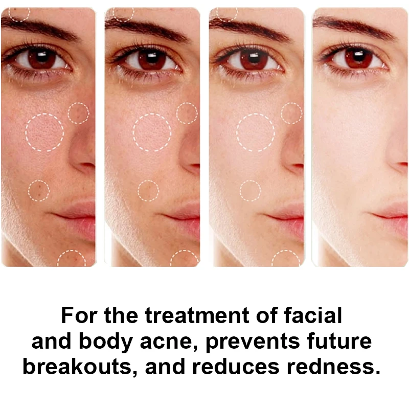 Private Label Pimples Spot Treatment 2.5% Benzoyl Peroxide Cream