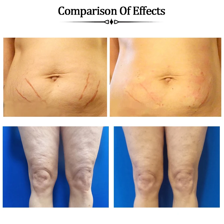 Korea new aqulift cog polydioxanone suture v line pdo thread lift needle Tornado screw 26G 60mm