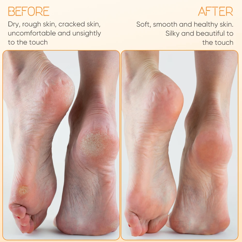 The New Pedicure Manicure Tools  Callus Remover Machine Set Products Foot Care Foot File Callus Remover Foot Skin Care