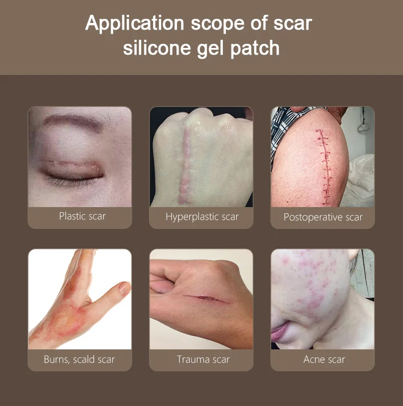 Silica Gel Repair New Product Effectively Removal Cream Silicone Gel Acne Scar