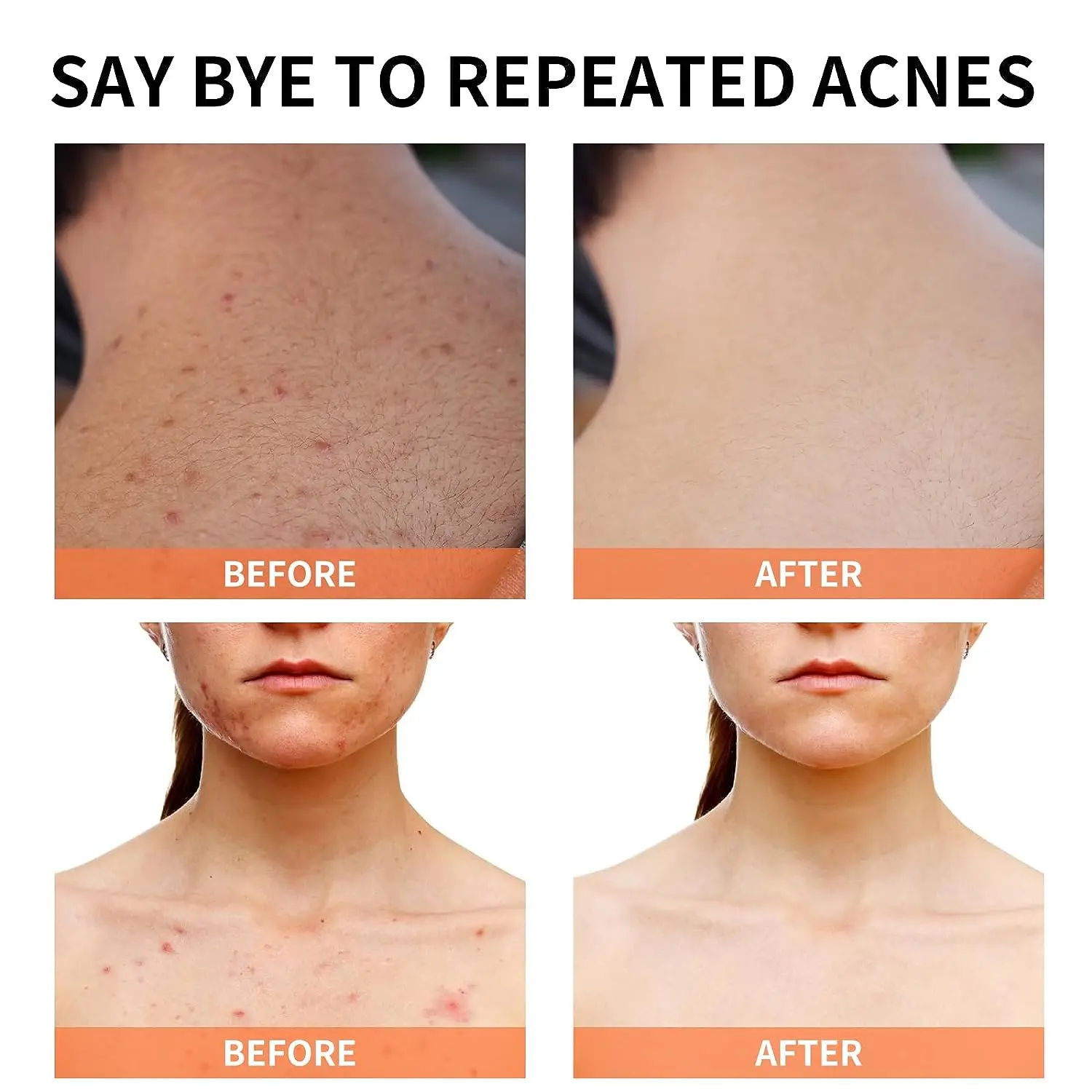 Натуральный веганский крем от акне с салициловой кислотой