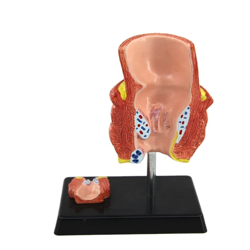 Medical Hemorrhoid Disease Model Anatomical Hemorrhoid Model