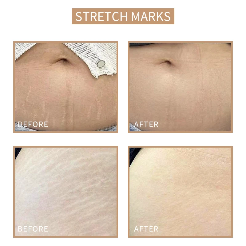 Private Label Stretch Mark Camouflage Vitiligo Pigment Semi Permanent Skin Micropigmentation kit