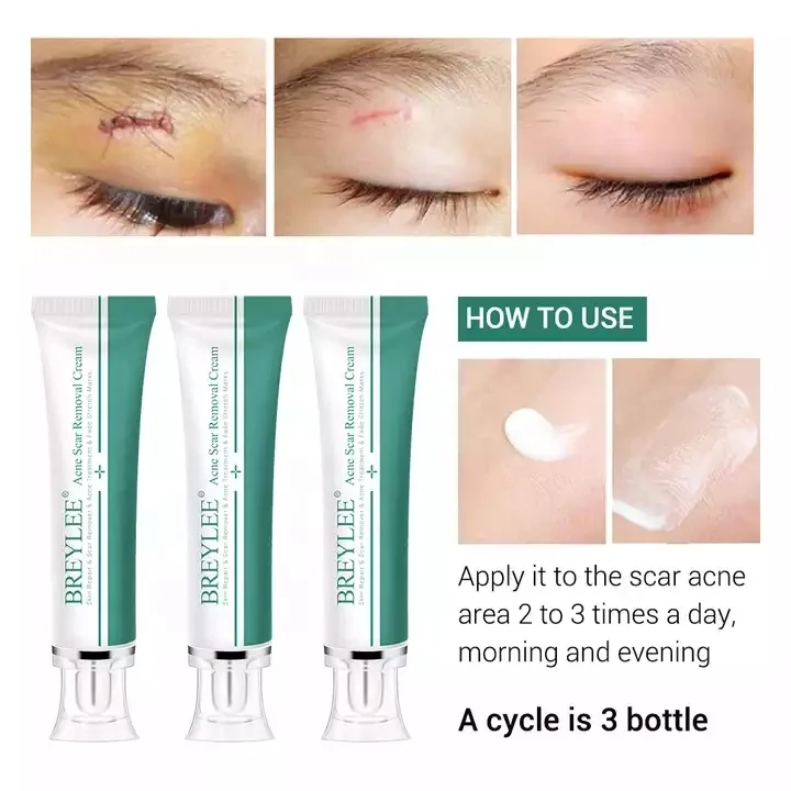 BREYLEE Natural Acne Treatment Skin Repair Stretch Marks Removal Acne Scar Removal Cream