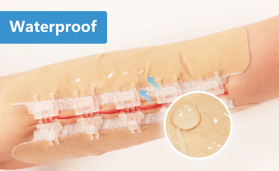 BLUENJOY Sterile Skin Color Wound Closure Device First Aid Wound Care Zip Stitch Wound Device