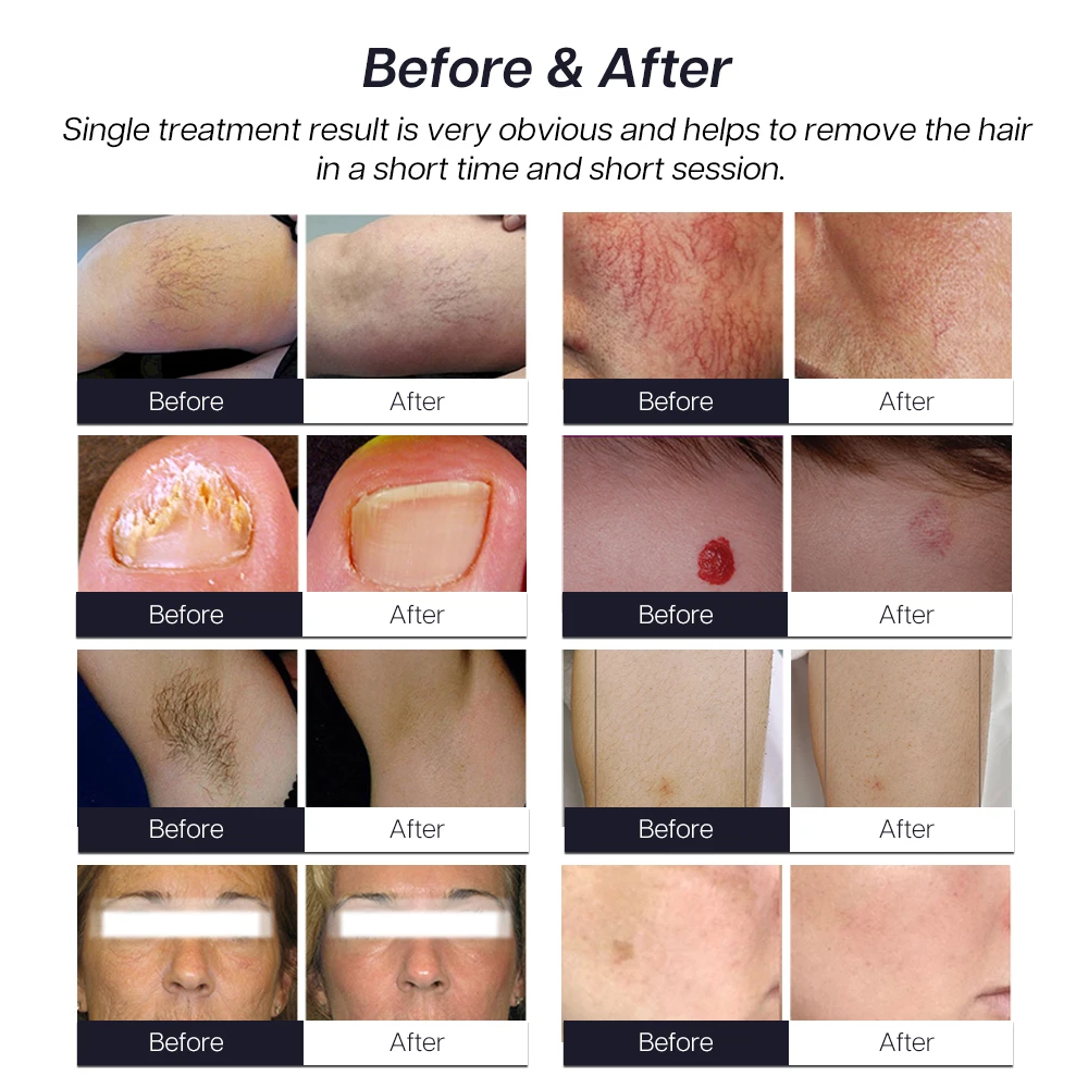 Alexpulse Nd Yag 755Nm 1064Nm Candle Lazer Alexandrite Laser Hair Removal Machine Price