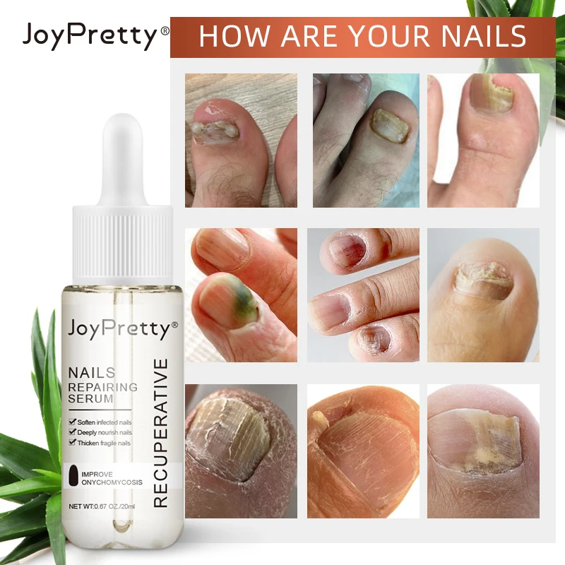 Nail Repair Serum Fungal Nail Treatment Toe Nourishing Repairing Hand Foot Care Remove Onychomycosis Serum