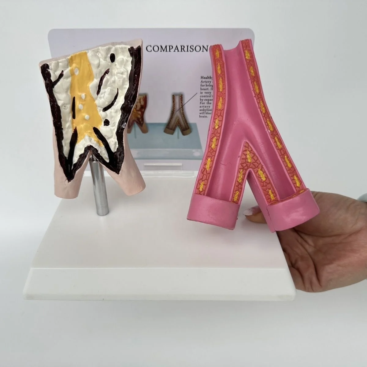 Medical Sciences Comparison Model Between Smoking Blood Vessels and Normal Blood Vessels  Artery Pathology Model