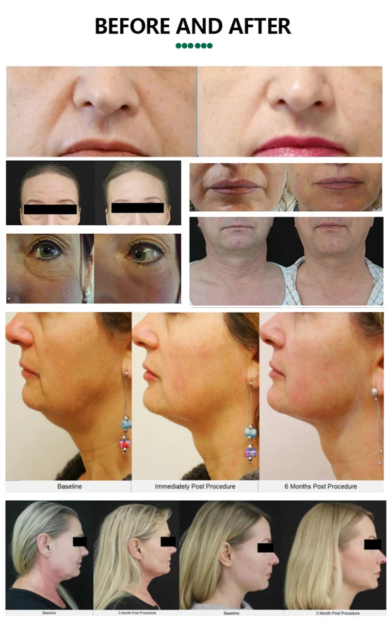 Portable Mini Focused 7d Vsmas slimming Machine Ultra Skin Tighten Body Contouring Anti Aging with 7 cartridges 