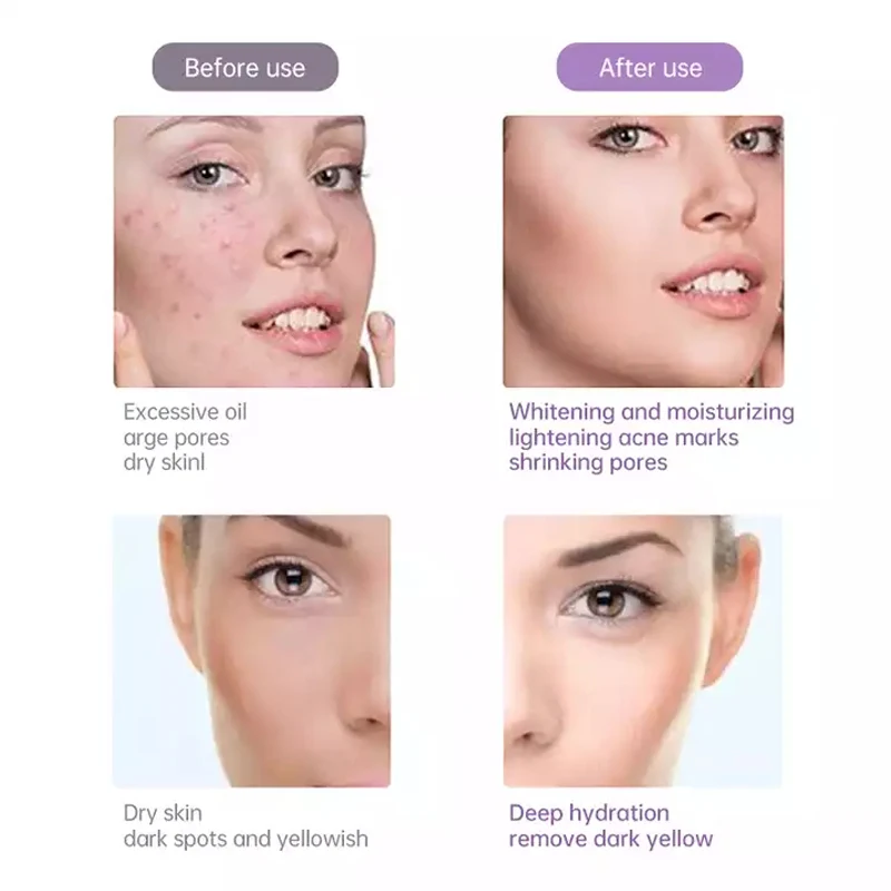 New arrival mesotherapy water injection meso needle-free mesotherapy domestos aqua facial hydro vacuum mesotherapy machine