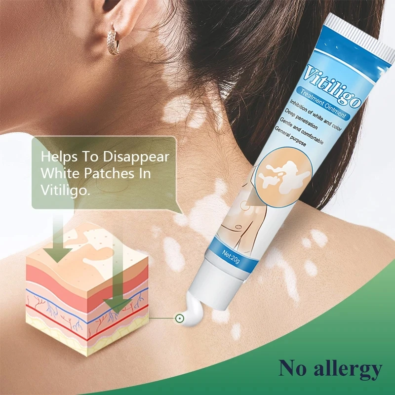 20g Herbal Extract Vitiligo Ointment Remove Ringworm White Spot Removal Skin Leukoplakia Disease Vitiligo Treatment Cream
