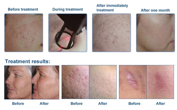 Desktop Non Ablative Fractional Laser Fractional Co2 Laser Beauty Laser Equipment