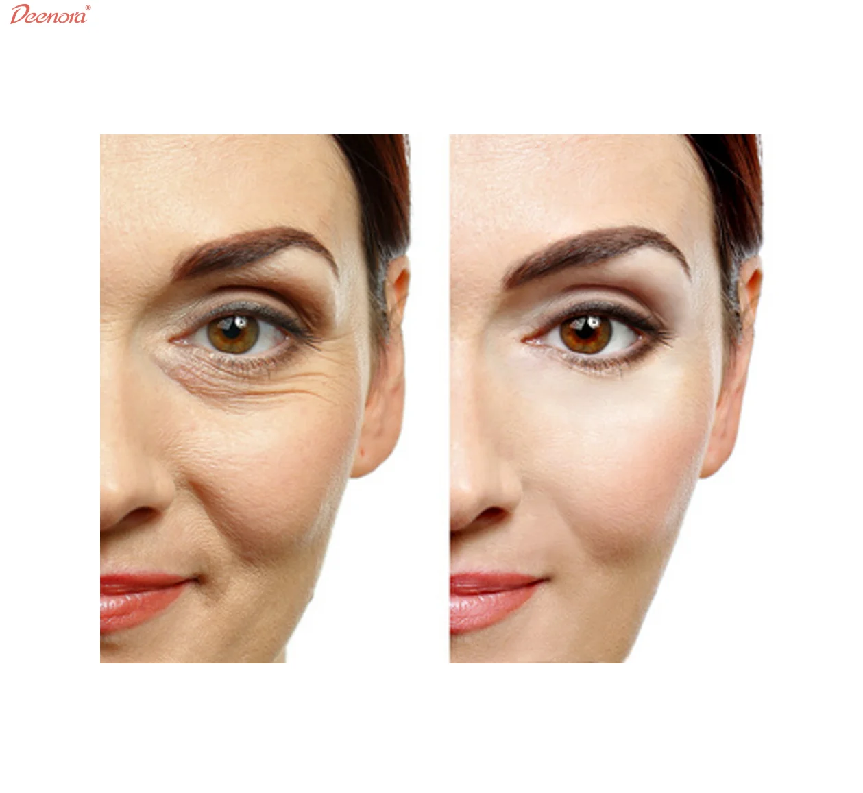 Deenora 2 boxes long lasting injection injectable acido hialuronico dermal filler for nose face penis enlargement