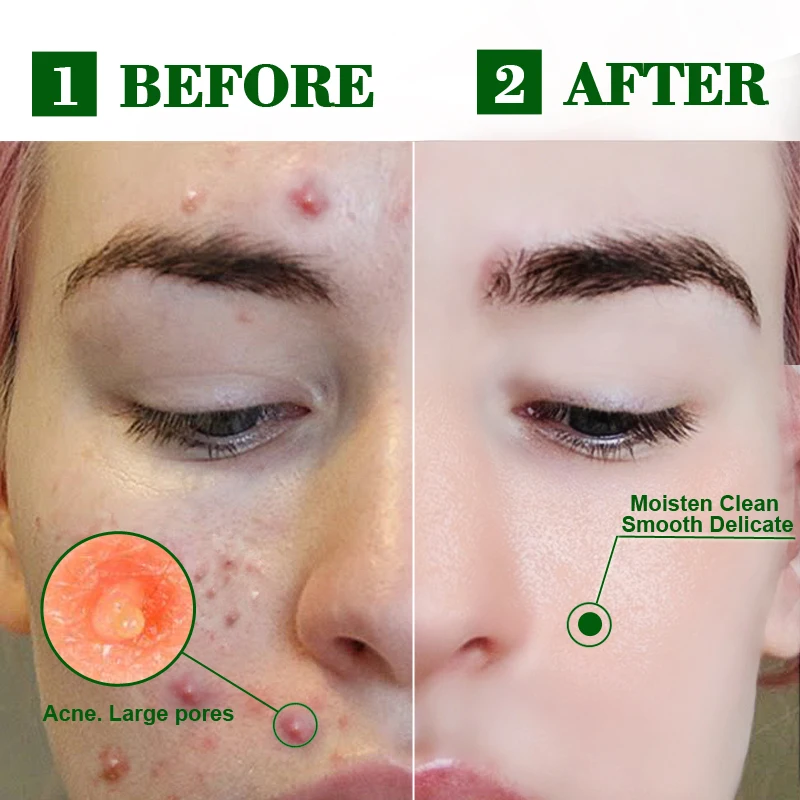 Oligopeptide acne cleaning lotion serum Vitamin A Oil Control Pore Refining Glycolic Acid Anti Acne Aha Serum