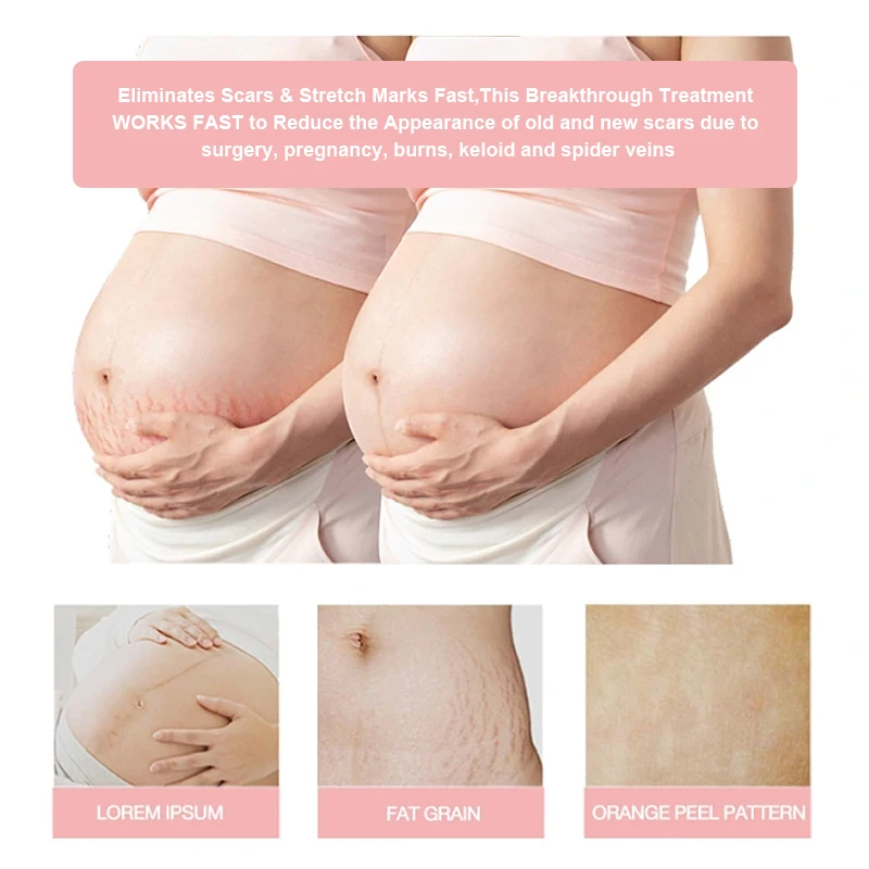 Oem/Odm Brand Dark Spot Repairing Acne Stretch Marks And Scar Removal Cream For Old Scars On Face