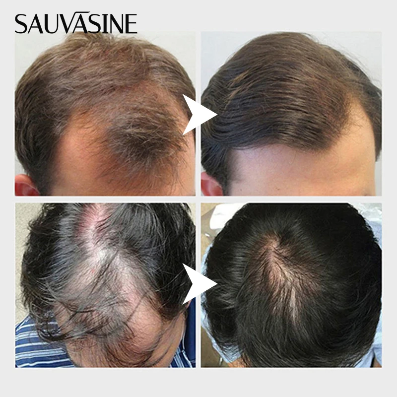 OEM Organic Regrowth Scalp Elixirs Black Rice Powerful Growth Oil Treatment Fast Rice Water Stop Hair Loss hair Growth Serum